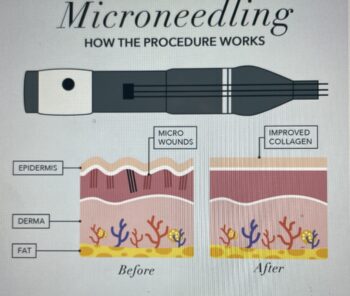 Microneedling diagram showing device and skin layers