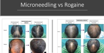 Microneedling vs Rogaine before-and-after photos