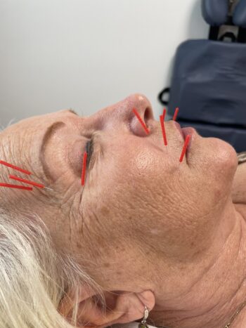 Facial acupuncture treatment with red needles
