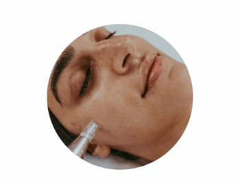 Woman receiving microneedling facial treatment